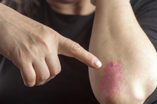 银屑病常见症状及俗称“牛皮癣”